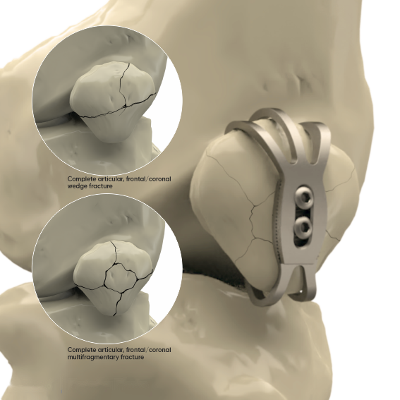 Plaques patellaires