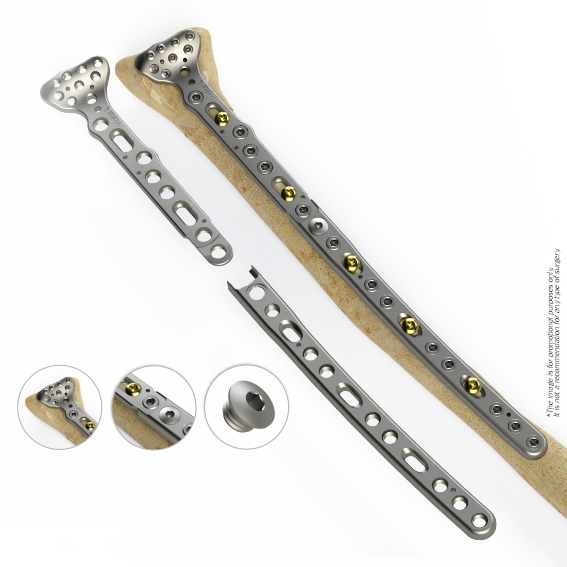 Plaque d'extension volaire du radius distal