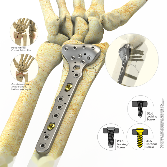Plaques du radius distal verrouillées volaire / grand