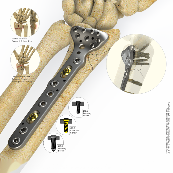 Plaques du radius distal verrouillées volaire
