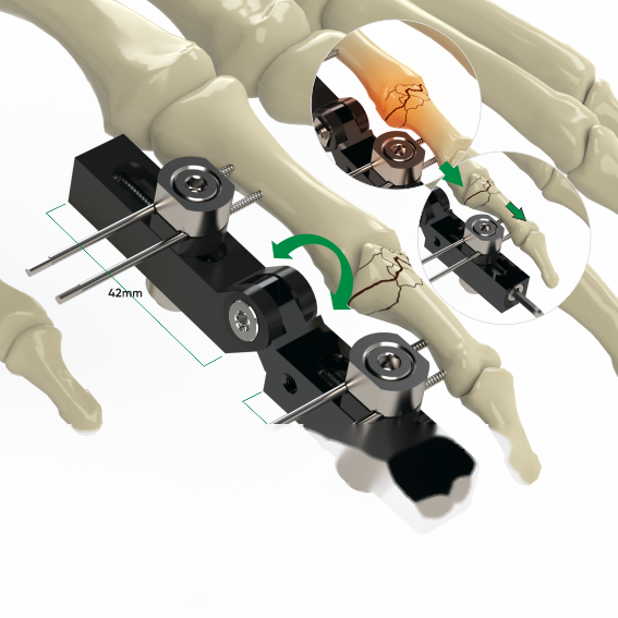 Fixateur de doigt (articulation)