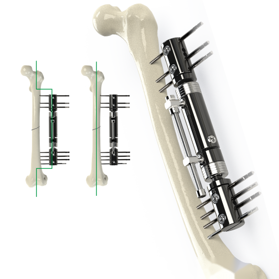 Fixateur externe axial dynamique (fémur-tibia)