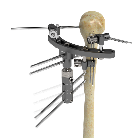 Fixateur externe hybride huméral (kit)