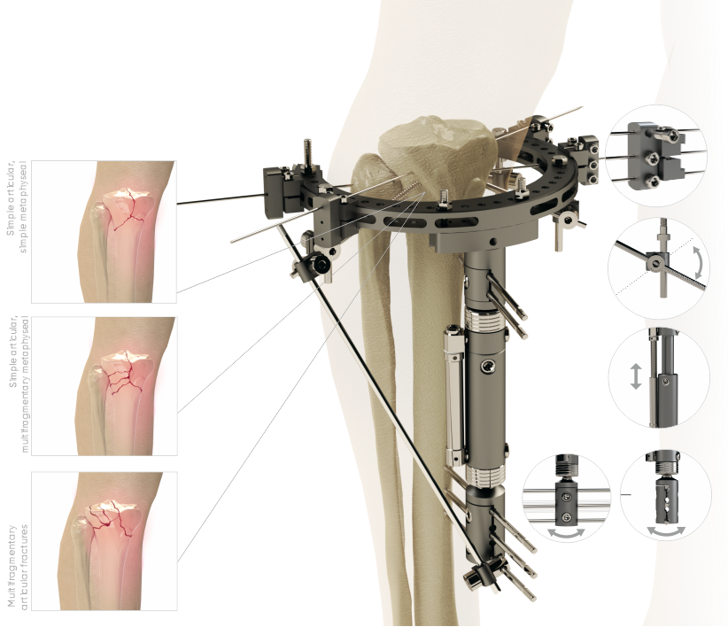 Fixateur hybride fémur-tibia