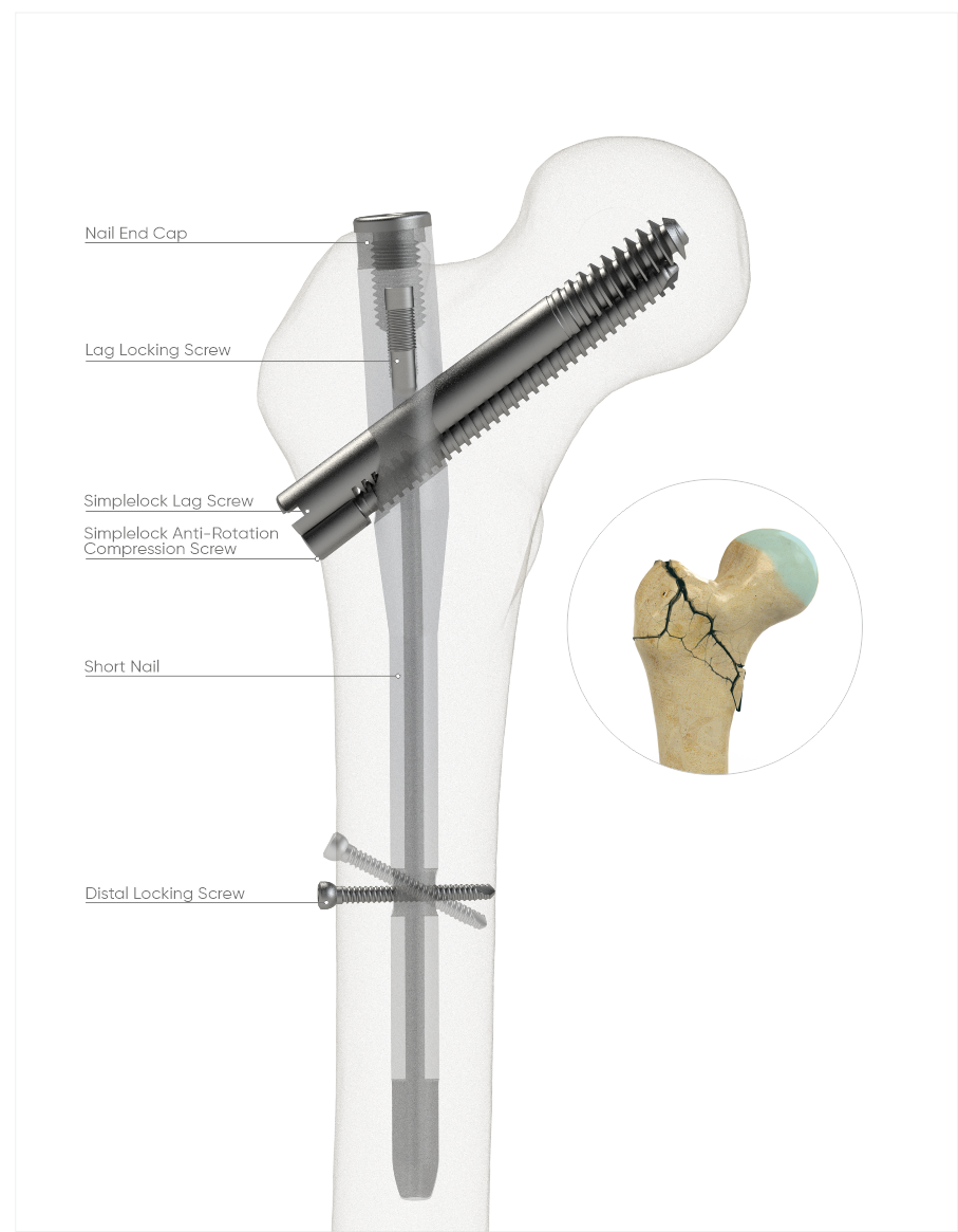 PFNA Simplelock