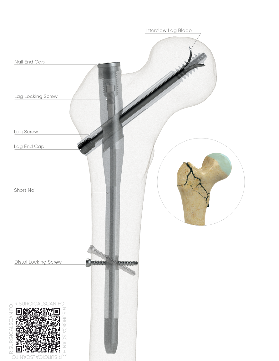 PFNA Interclaw