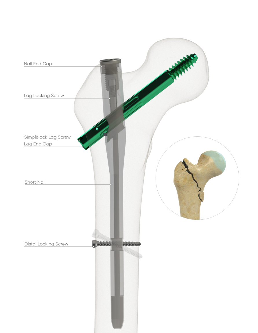 Vis de compression PFNA