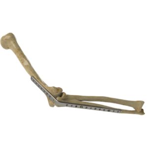 Elbow (Arthrodesis) Plate