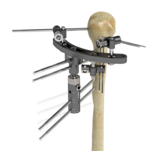 Humerus Hybrit External Fixator (Kit)