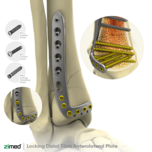 Locking Distal Anterolateral Tibial Plate