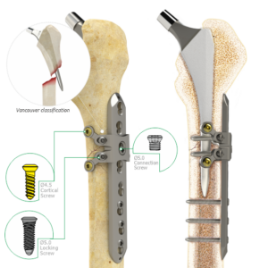 Locking Attachment Plate