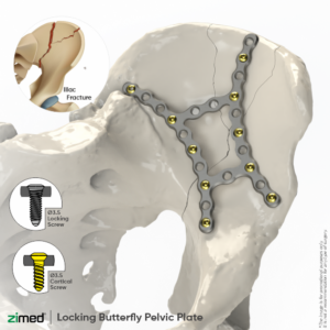 Locking Butterfly Pelvic Plates