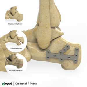 Locking Calcaneal F Plates