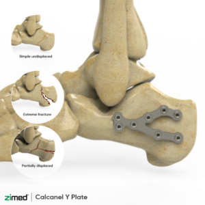 Locking Calcaneal Y Plates