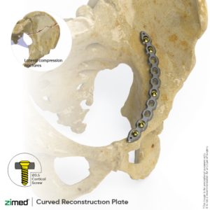 Curved Reconstruction Plates