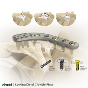 Locking Distal Clavicle Plates