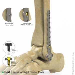 Locking Distal Fibular Plates