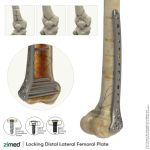 Locking Distal Lateral Femoral Plates