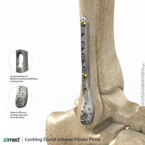 Locking Distal Lateral Fibula Plates