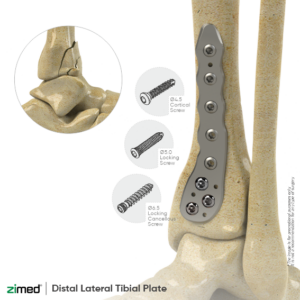 Locking Distal Lateral Tibial Plate