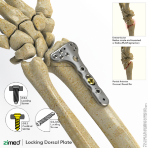 Locking Distal Radius Plates - Dorsal
