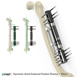 Dynamic Axial External Fixator (Femur - Tibia )