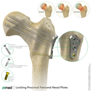 Locking Proximal Lateral Femoral Head Plates