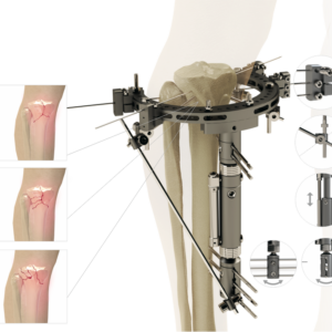 Femur-Tibia Hybrid Fixator