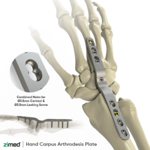 Hand Carpus (Arthrodesis) Plate