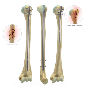 Cannulated Intramedullary Humeral Nail System