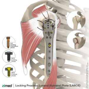Locking Proximal Lateral Humeral Plates (LARGE)