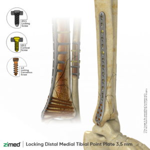 Locking Distal Medial Tibial Point Plates 3.5 Mm