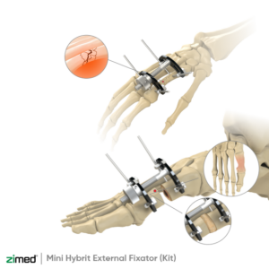 Mini Hybrit External Fixator (Kit)