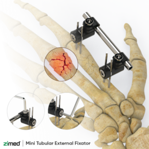 Mini Tubular External Fixator (Kit)