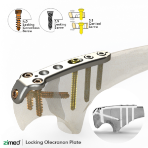 Locking Olecranon Plates