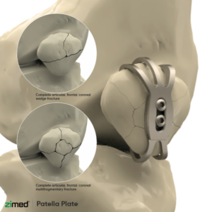 Patella Plates