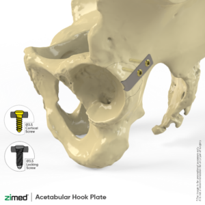 Acetabular Hook Plates
