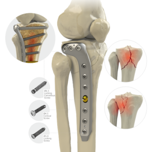 Locking Proximal Lateral Tibial L Plate