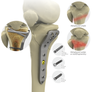 Locking Proximal Medial Tibial Plate