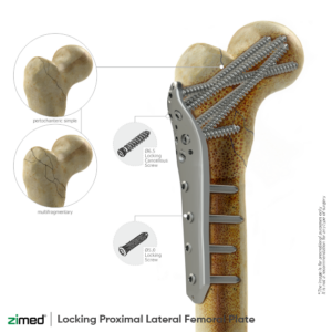 Locking Proximal Lateral Femoral Plate