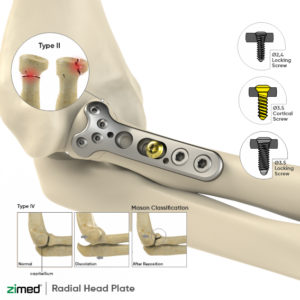 Locking Proximal Radial Head Plates