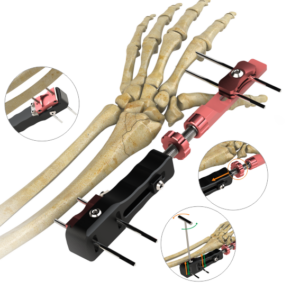 Radiolucent Compression Hand-Wrist Fixator (Kit)