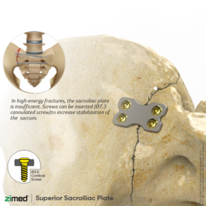 Superior Sacroiliac Plates