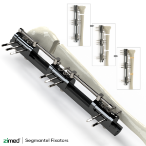 Segmantel Fixators