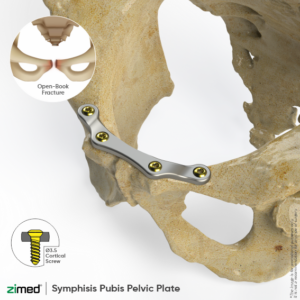 Symphisis Pubis Pelvic Plates