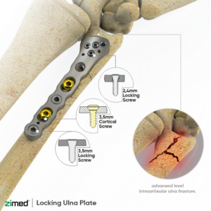 Locking Distal Ulna Plates
