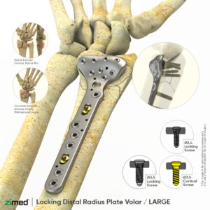 Locking Distal Radius Plates - Volar / LARGE