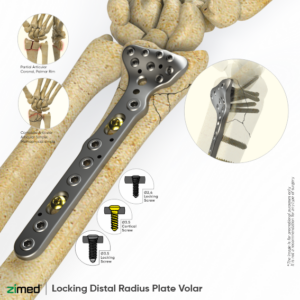 Locking Distal Radius Plates - Volar