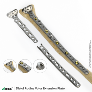 Distal Radius Volar Extension Plate